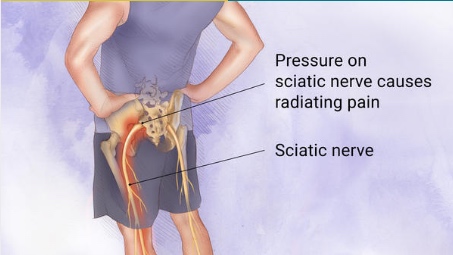 https://nepalpaincarecenter.com/wp-content/uploads/2020/08/Sciatic-Pain.jpg