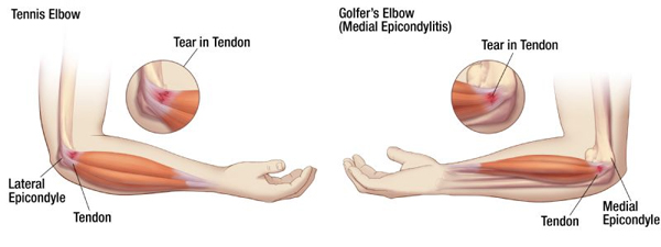 https://nepalpaincarecenter.com/wp-content/uploads/2020/08/Tennis-elbow-and-golfers-elbow.jpg