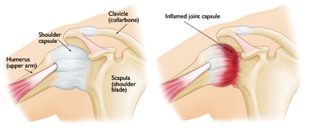 https://nepalpaincarecenter.com/wp-content/uploads/2020/08/frozen-shoulder.jpg