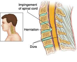 https://nepalpaincarecenter.com/wp-content/uploads/2020/08/hern_dis.jpg