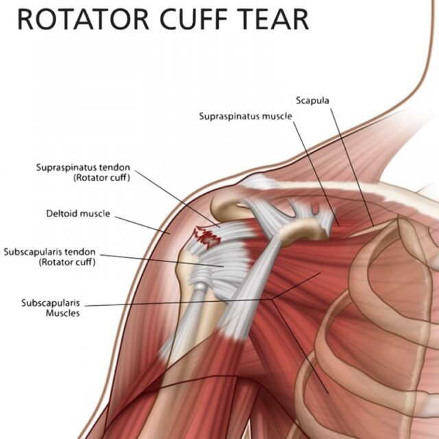https://nepalpaincarecenter.com/wp-content/uploads/2020/08/rotator-cuff-tear-edit-768x768-1-640x640.jpg