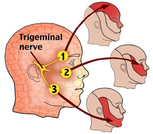 https://nepalpaincarecenter.com/wp-content/uploads/2020/08/trigeminal-neuralgia-300x263-300x263-1.jpg